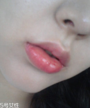 嘟嘟唇幾天消腫 一般是一周 嘟嘟唇幾天消腫 一般是一周
