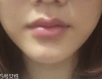 嘟嘟唇不想要了怎么辦 嘟嘟唇不想要了怎么辦