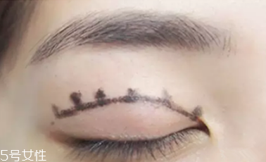 納米無痕雙眼皮是埋線嗎 納米無痕雙眼皮介紹 納米無痕雙眼皮是埋線嗎 納米無痕雙眼皮介紹