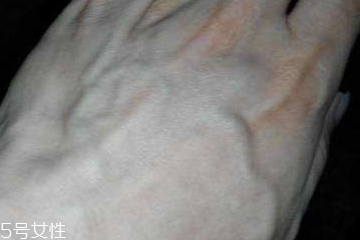 男性青筋凸起要注意 是個慢性炸彈 男性青筋凸起要注意 是個慢性炸彈