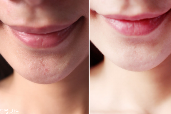 微針去痘印需要注意什么 還你潔白無瑕肌膚 微針去痘印需要注意什么 還你潔白無瑕肌膚