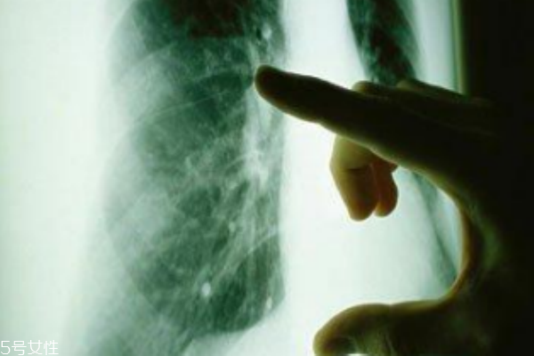 揪出早期肺癌 低劑量電腦斷層檢查 揪出早期肺癌 低劑量電腦斷層檢查