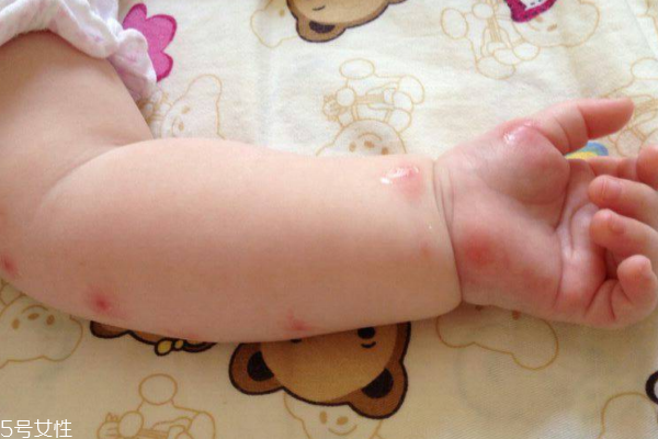 蚊子喜歡叮咬什么樣的人 這些人最容易中招 蚊子喜歡叮咬什么樣的人 這些人最容易中招