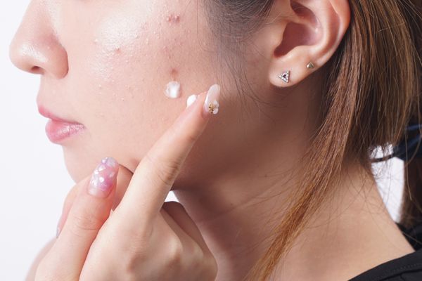 暗瘡怎么能快速消腫 內(nèi)服外用消滅暗瘡 暗瘡怎么能快速消腫 內(nèi)服外用消滅暗瘡