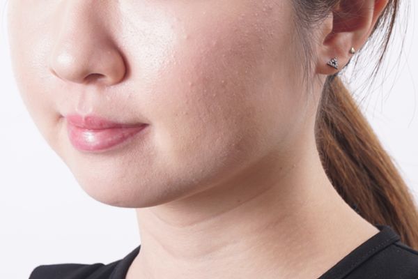 暗瘡怎么能快速消腫 內(nèi)服外用消滅暗瘡 暗瘡怎么能快速消腫 內(nèi)服外用消滅暗瘡