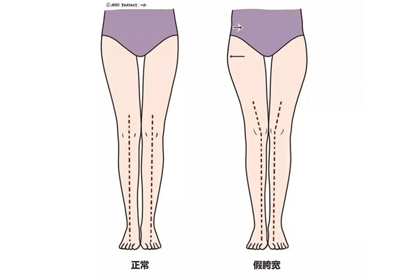 假胯寬是怎么形成的 不良走姿害了你 假胯寬是怎么形成的 不良走姿害了你