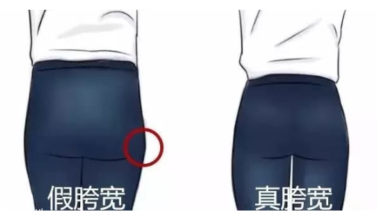 假胯寬是怎么形成的 不良走姿害了你 假胯寬是怎么形成的 不良走姿害了你