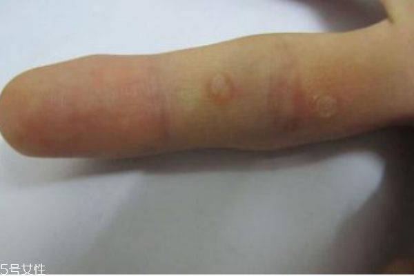 手上長了個硬疙瘩怎么回事 手上長了個硬疙瘩像繭 手上長了個硬疙瘩怎么回事 手上長了個硬疙瘩像繭