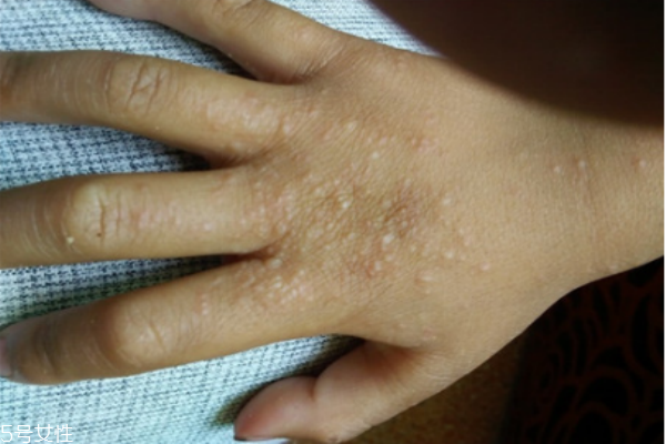 手上長了個硬疙瘩怎么回事 手上長了個硬疙瘩像繭 手上長了個硬疙瘩怎么回事 手上長了個硬疙瘩像繭