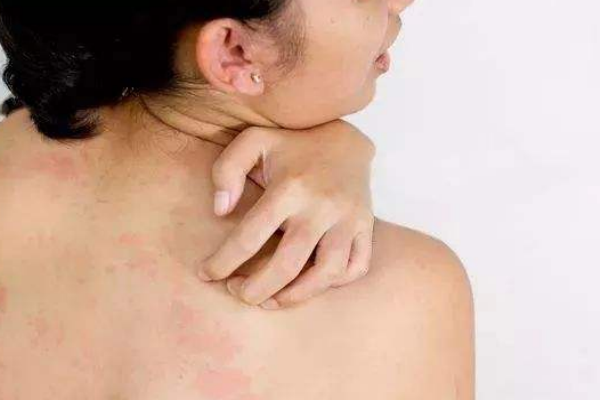 蕁麻疹與血管性水腫如何治療與居家護理 蕁麻疹與血管性水腫如何治療與居家護理