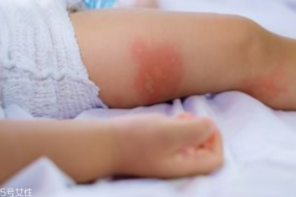 寶寶濕疹是怎么引起的 正確護理寶寶的方式 寶寶濕疹是怎么引起的 正確護理寶寶的方式