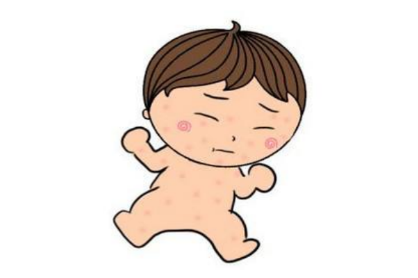 嬰兒干性濕疹怎辦 教你如何區(qū)分濕疹 嬰兒干性濕疹怎辦 教你如何區(qū)分濕疹
