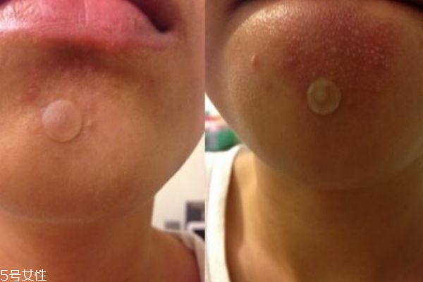 曼秀雷頓痘痘貼怎么樣 痘貼的正確使用方式 曼秀雷頓痘痘貼怎么樣 痘貼的正確使用方式