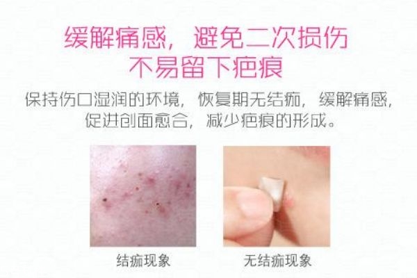 曼秀雷頓痘痘貼怎么樣 痘貼的正確使用方式 曼秀雷頓痘痘貼怎么樣 痘貼的正確使用方式