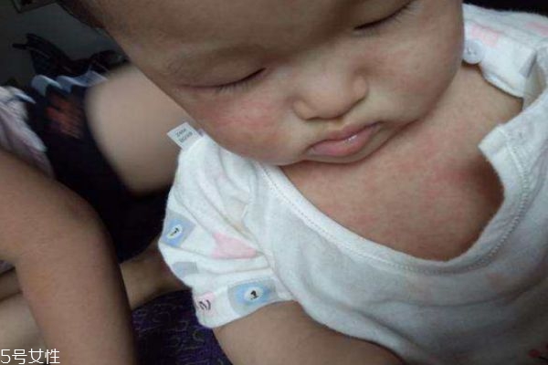 幼兒急疹和感冒發(fā)燒的區(qū)別 幼兒急疹的臨床癥狀 幼兒急疹和感冒發(fā)燒的區(qū)別 幼兒急疹的臨床癥狀