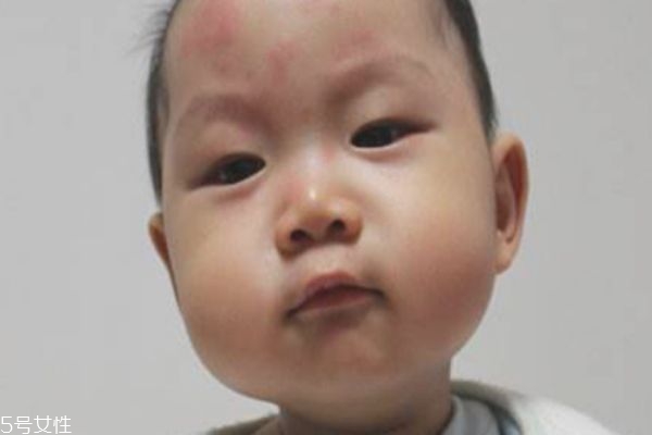 幼兒急疹和感冒發(fā)燒的區(qū)別 幼兒急疹的臨床癥狀 幼兒急疹和感冒發(fā)燒的區(qū)別 幼兒急疹的臨床癥狀