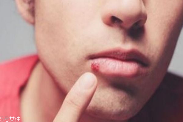 嘴巴長皰疹怎么辦 有可能引發(fā)這些疾病 嘴巴長皰疹怎么辦 有可能引發(fā)這些疾病
