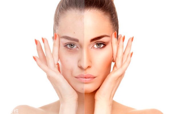 怎么判斷是不是激素臉 激素皮炎的幾種表現(xiàn) 怎么判斷是不是激素臉 激素皮炎的幾種表現(xiàn)