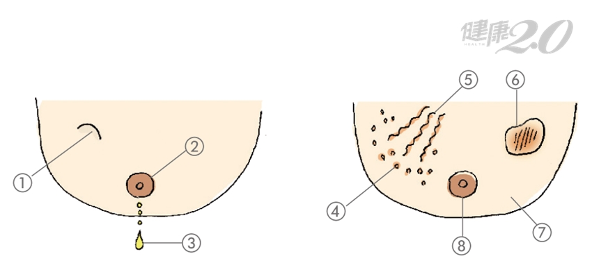 怎樣判斷乳房健康 每月3步驟自我檢查 怎樣判斷乳房健康 每月3步驟自我檢查