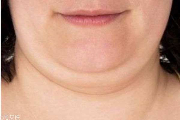 面部吸脂危險嗎 面部吸脂之后有什么危害 面部吸脂危險嗎 面部吸脂之后有什么危害