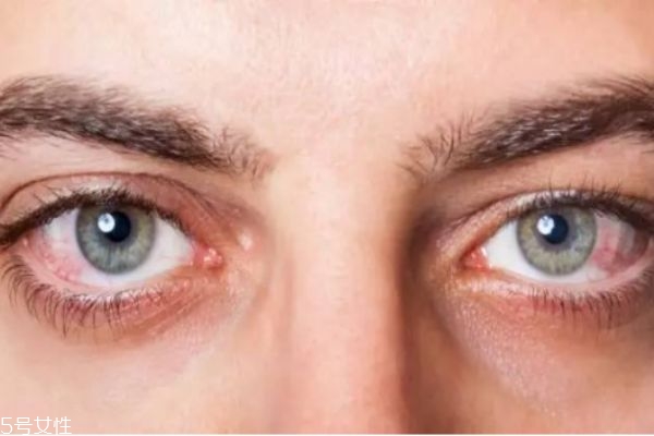 眼睛刺痛是怎么回事 眼睛總是發(fā)癢還有刺痛感 眼睛刺痛是怎么回事 眼睛總是發(fā)癢還有刺痛感