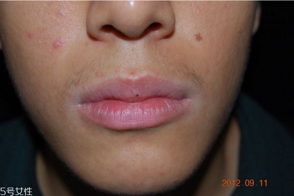 唇炎是怎么引起的 唇炎怎么治療好的快 唇炎是怎么引起的 唇炎怎么治療好的快