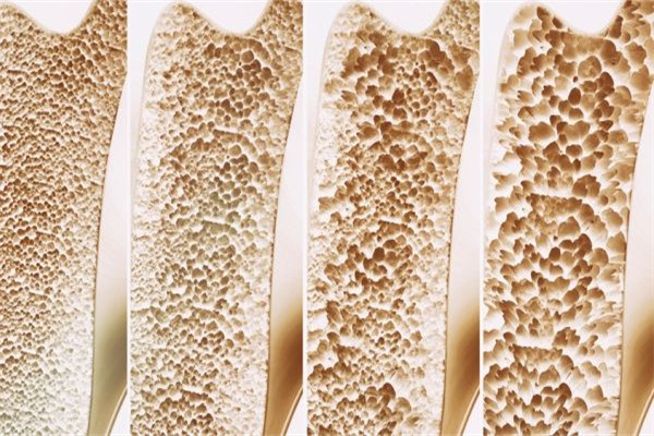 骨質(zhì)疏松吃什么好 骨質(zhì)疏松食譜 骨質(zhì)疏松吃什么好 骨質(zhì)疏松食譜