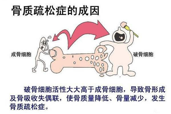 骨質(zhì)疏松吃什么好 骨質(zhì)疏松食譜 骨質(zhì)疏松吃什么好 骨質(zhì)疏松食譜