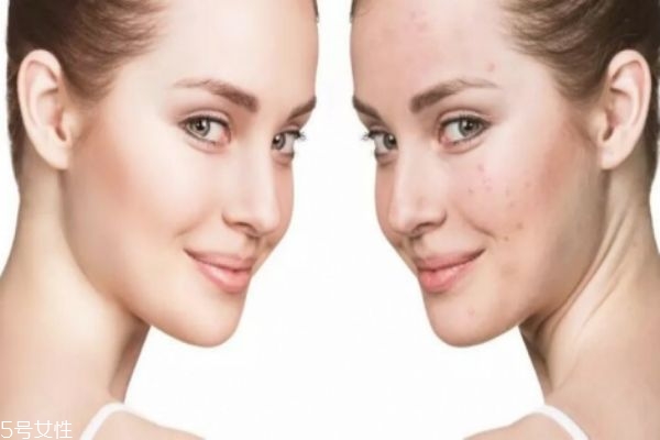 油皮痘痘肌用什么卸妝 這樣才卸的干凈 油皮痘痘肌用什么卸妝 這樣才卸的干凈