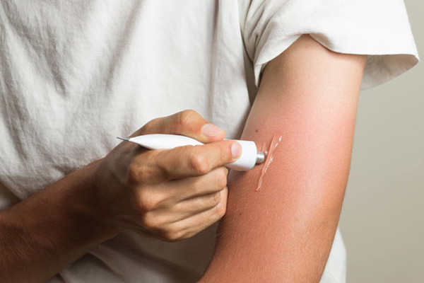 曬傷后怎么變白 方法是這樣 曬傷后怎么變白 方法是這樣