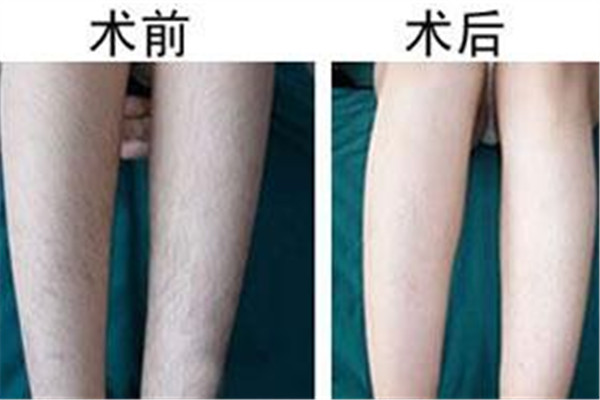 汗毛多怎么去除 汗毛多是什么原因 汗毛多怎么去除 汗毛多是什么原因