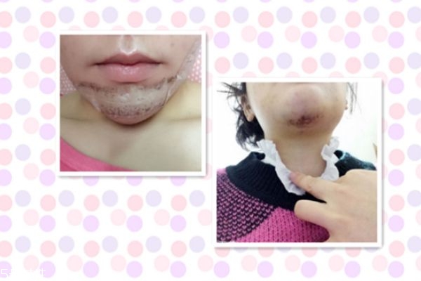 墊下巴能改變臉型嗎 墊下巴后恢復(fù)過程 墊下巴能改變臉型嗎 墊下巴后恢復(fù)過程