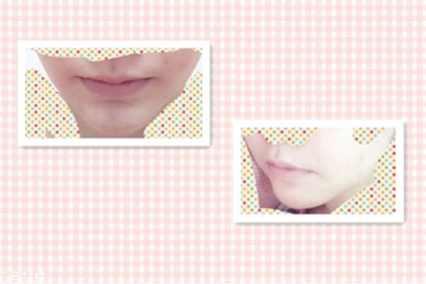 墊下巴能改變臉型嗎 墊下巴后恢復(fù)過程 墊下巴能改變臉型嗎 墊下巴后恢復(fù)過程