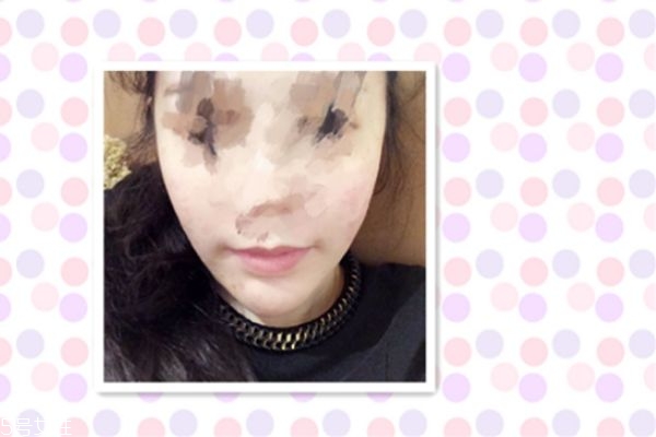 墊下巴能改變臉型嗎 墊下巴后恢復(fù)過程 墊下巴能改變臉型嗎 墊下巴后恢復(fù)過程