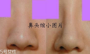 鼻頭縮小術有風險嗎 鼻頭縮小術有風險嗎