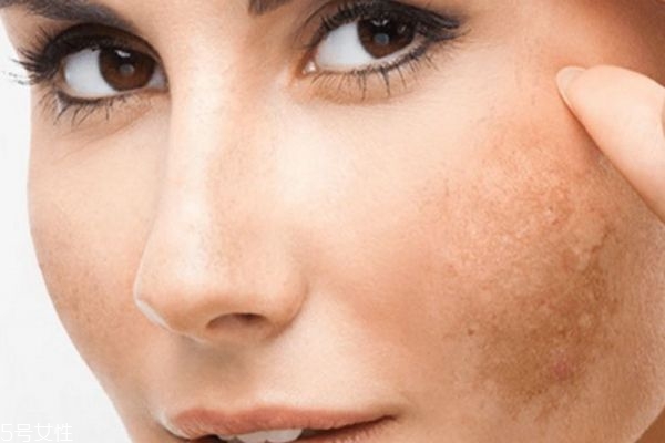 黃褐斑怎么內調 黃褐斑治療方法 黃褐斑怎么內調 黃褐斑治療方法