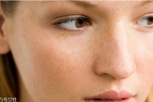 黃褐斑怎么內調 黃褐斑治療方法 黃褐斑怎么內調 黃褐斑治療方法