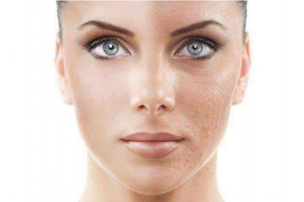 果酸換膚多少錢一次 正規(guī)醫(yī)院果酸換膚價(jià)格 果酸換膚多少錢一次 正規(guī)醫(yī)院果酸換膚價(jià)格