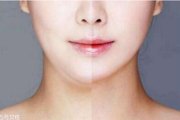 面部吸脂疼嗎 哪些人不能做臉部抽脂 面部吸脂疼嗎 哪些人不能做臉部抽脂