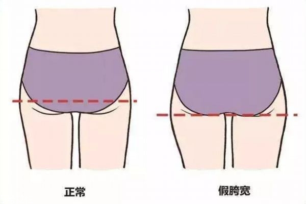 假胯寬可以用收胯帶嗎 真胯寬和假胯寬的區(qū)別 假胯寬可以用收胯帶嗎 真胯寬和假胯寬的區(qū)別