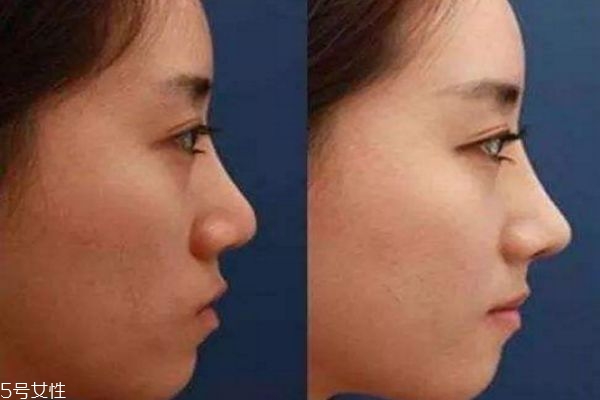 鼻基底填充是什么 關(guān)于鼻基底填充 鼻基底填充是什么 關(guān)于鼻基底填充