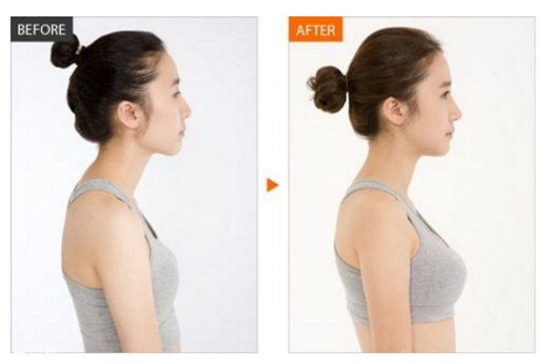 假體隆胸多久變軟 怎樣使假體隆胸手感更真實 假體隆胸多久變軟 怎樣使假體隆胸手感更真實