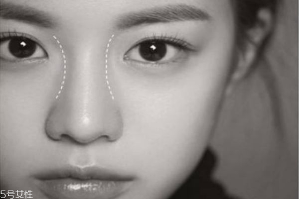 墊鼻基底的切口在哪里 墊鼻基底術后注意事項 墊鼻基底的切口在哪里 墊鼻基底術后注意事項