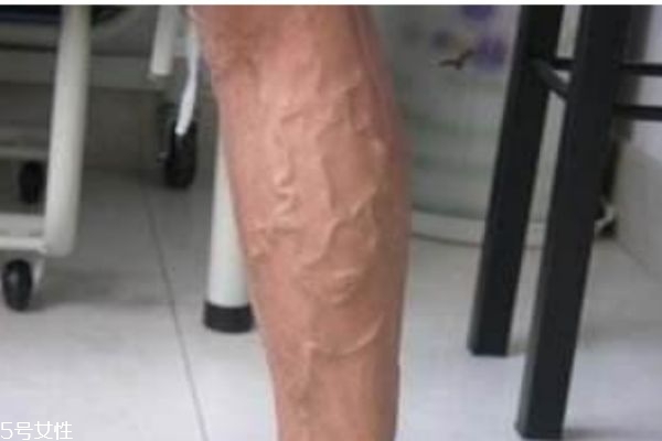 什么是經(jīng)脈曲張 將脈曲張的危害是什么 什么是經(jīng)脈曲張 將脈曲張的危害是什么