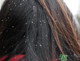 頭皮屑多又癢怎么辦?頭皮屑又多又癢怎么去除? 頭皮屑多又癢怎么辦?頭皮屑又多又癢怎么去除?