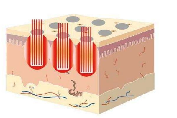 點(diǎn)陣激光有什么用呢 點(diǎn)陣激光有什么危害嗎 點(diǎn)陣激光有什么用呢 點(diǎn)陣激光有什么危害嗎