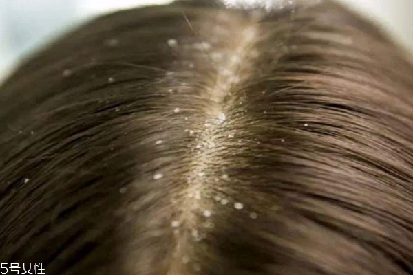 頭皮屑造成的原因有什么呢 頭皮屑太多應(yīng)該怎么辦呢 頭皮屑造成的原因有什么呢 頭皮屑太多應(yīng)該怎么辦呢