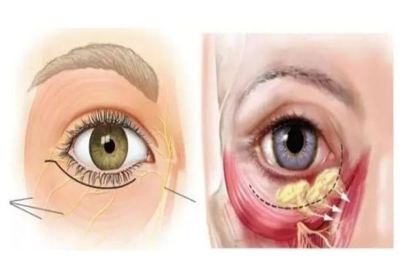 怎么可以消除眼袋呢 眼袋可以怎么預(yù)防呢 怎么可以消除眼袋呢 眼袋可以怎么預(yù)防呢