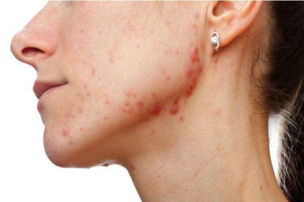 下巴上長痘痘是什么原因 下巴長痘痘怎么快速去除 下巴上長痘痘是什么原因 下巴長痘痘怎么快速去除