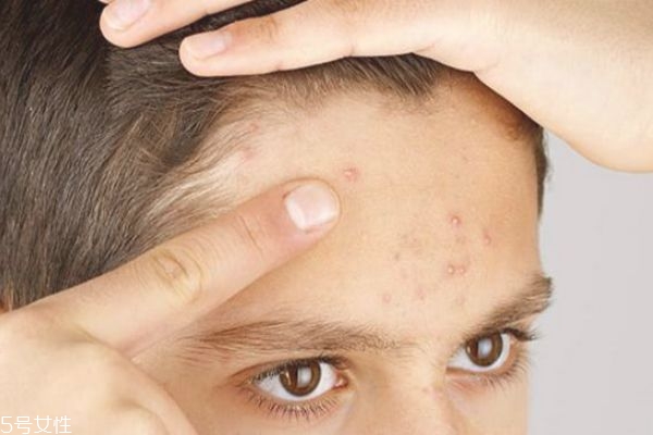 怎么去閉口粉刺 去閉口粉刺最有效的方法 怎么去閉口粉刺 去閉口粉刺最有效的方法